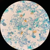 腟炎　トリコモナス原虫弱拡大