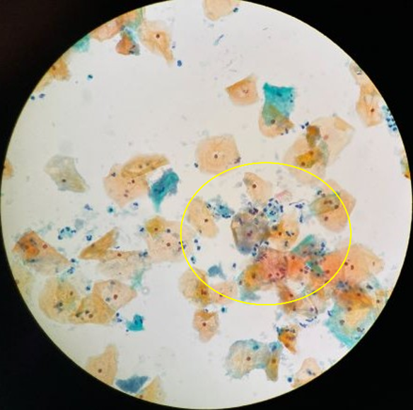 細菌性腟症の弱拡大
