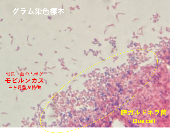 グラム染色した標本の腟ガルドネラ菌とモビルンカス」