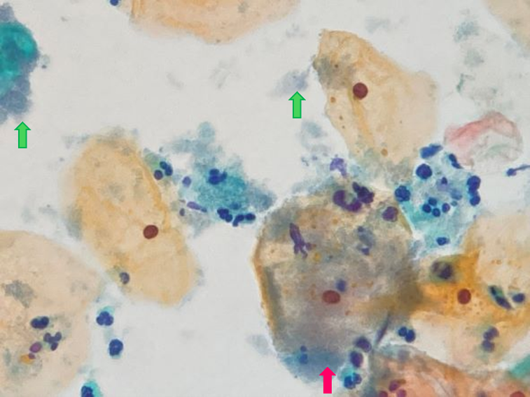 細菌性腟症　クルーセルの強拡大