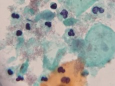 細菌性腟症のBV-1に相当する細胞