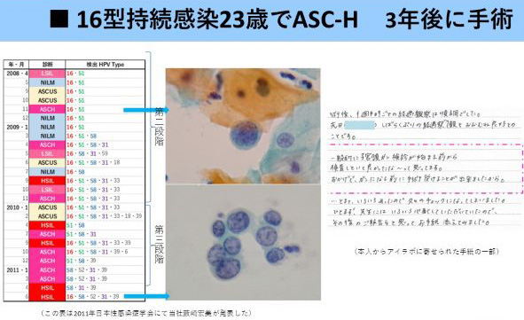 子宮頸がん検査キット